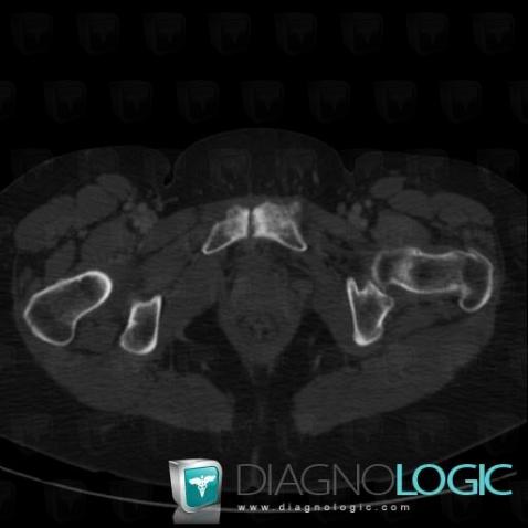 Degenerative joint disease, Pubic symphysis, CT