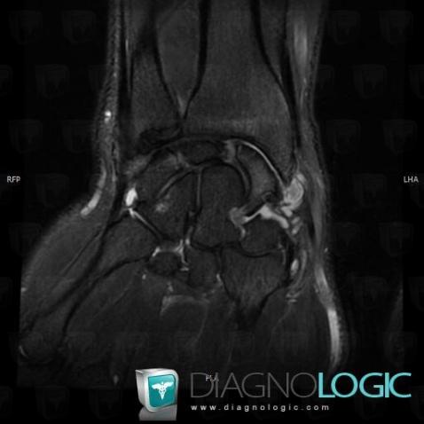 Degenerative joint disease, Radio/Ulno carpal joint, MRI