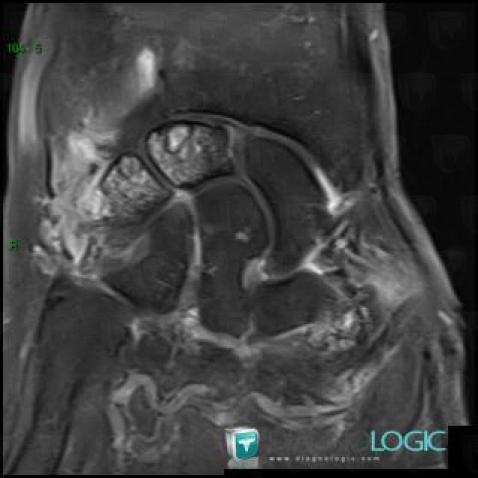 Degenerative joint disease, Scaphoid, Lunate, MRI