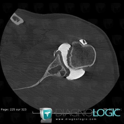 Degenerative joint disease, Scapula, CT