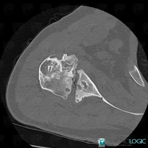 Degenerative joint disease, Scapula, CT