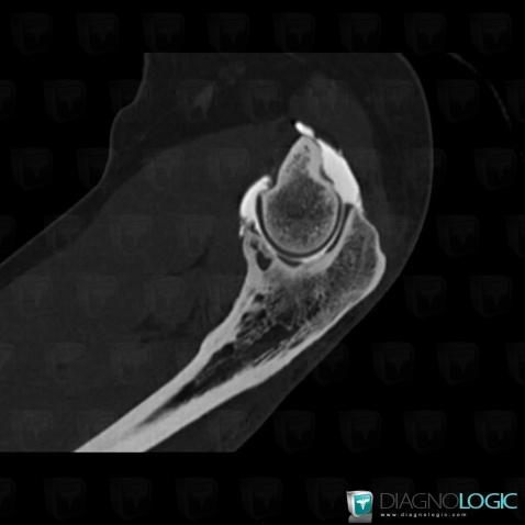 Radiology case : Degenerative joint disease (CT) - Diagnologic