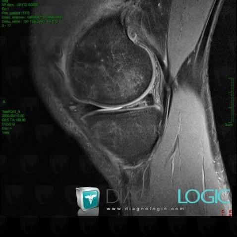 Degenerative meniscal tear, Meniscus, MRI