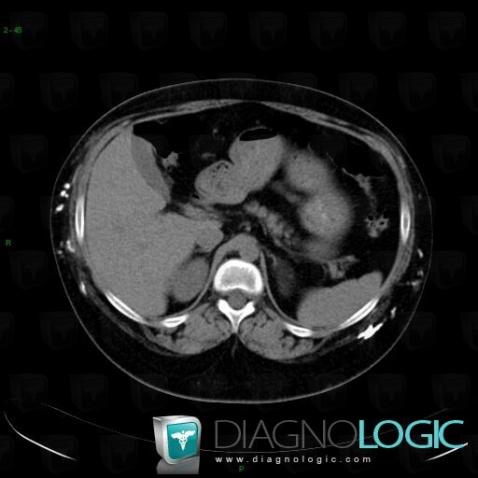 Dermatomyositis, Abdominal wall, CT