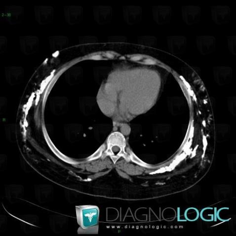 Dermatomyositis, Chest wall, CT