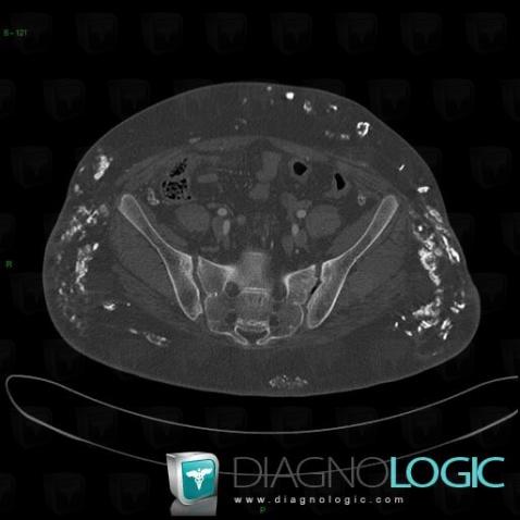 Dermatomyositis, Other soft tissues/nerves - Pelvis, CT