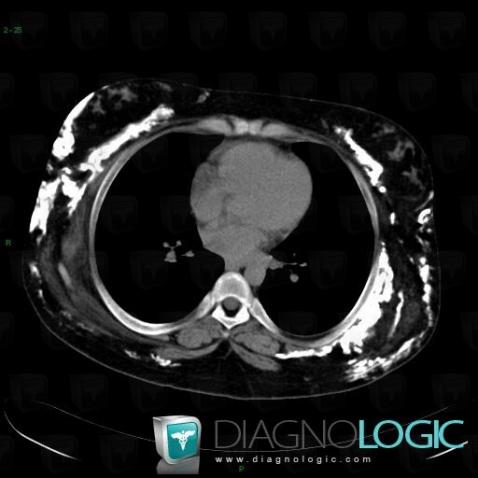 Dermatomyositis, Other soft tissues/nerves - Shoulder, CT