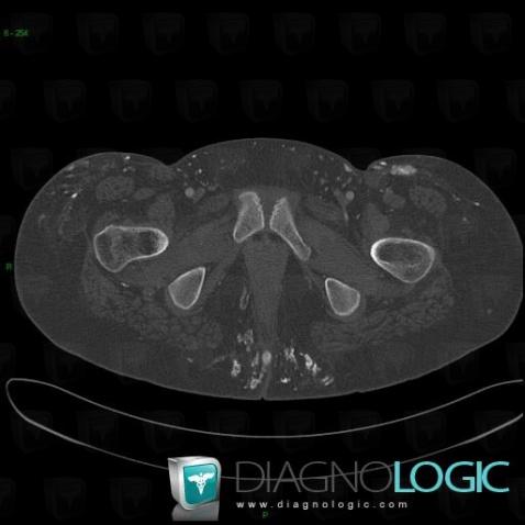 Dermatomyositis, Other soft tissues/nerves - Thigh, CT