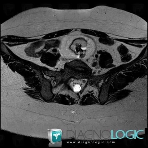 Dermoid cyst, Adnexa / Ovary fallopian tube, MRI