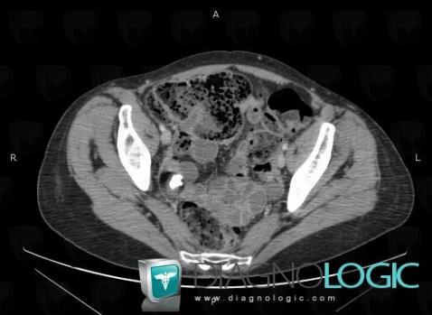 Dermoid cyst, Adnexa / Ovary fallopian tube, Pelvis / Perineum, CT