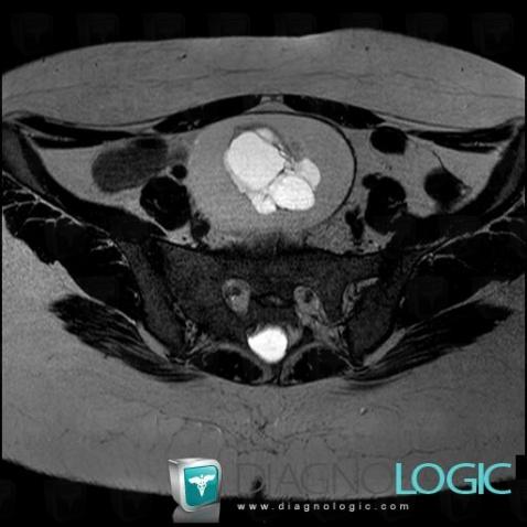 Dermoid cyst, Adnexa / Ovary fallopian tube, Pelvis / Perineum, MRI