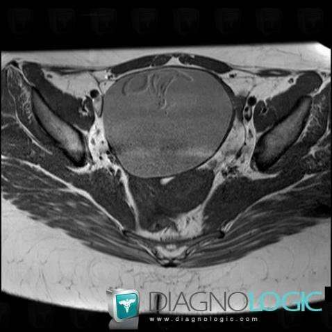 Dermoid cyst, Adnexa / Ovary fallopian tube, Pelvis / Perineum, MRI