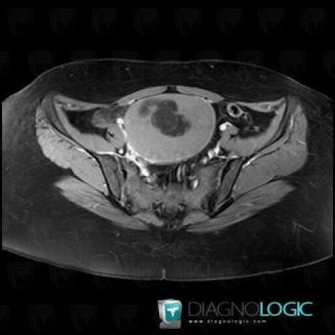 Dermoid cyst, Adnexa / Ovary fallopian tube, Pelvis / Perineum, MRI