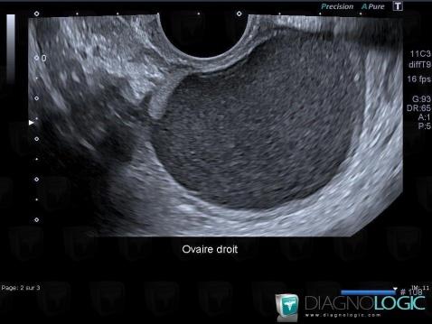 Dermoid cyst, Adnexa / Ovary fallopian tube, Pelvis / Perineum, US