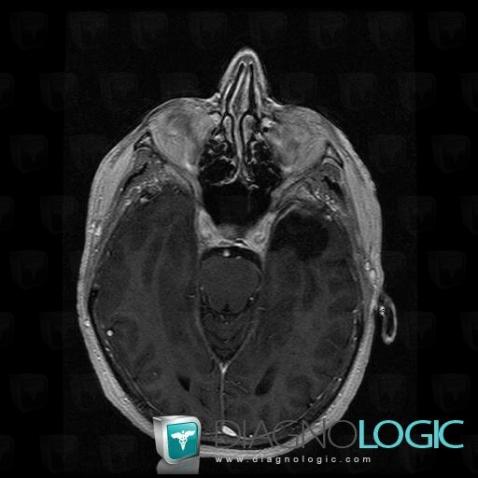 Dermoid cyst, Cerebral hemispheres, MRI