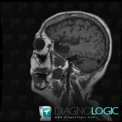 Dermoid cyst, Cerebral hemispheres, MRI