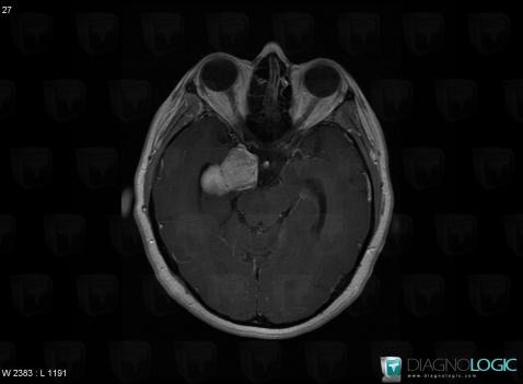 Dermoid cyst, Cerebral hemispheres, MRI