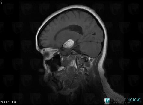 Dermoid cyst, Cerebral hemispheres, MRI