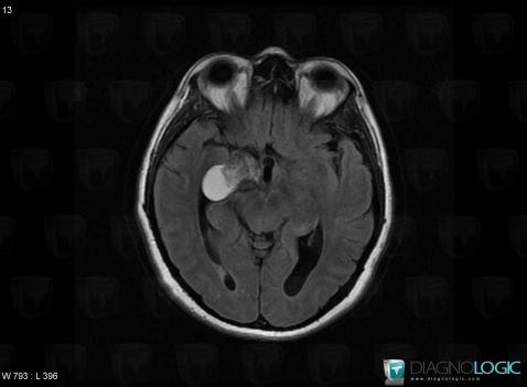 Dermoid cyst, Cerebral hemispheres, Pituitary gland and parasellar region, MRI