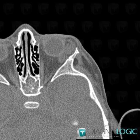 Dermoid cyst, Eye, CT