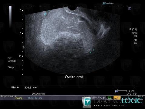 Dermoid cyst, Pelvis / Perineum, US