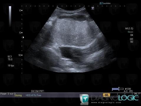 Dermoid cyst, Pelvis / Perineum, US