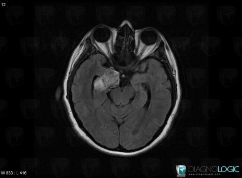 Dermoid cyst, Pituitary gland and parasellar region, MRI