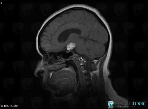 Dermoid cyst, Pituitary gland and parasellar region, MRI