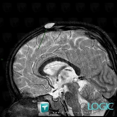 Dermoid cyst, Skull vault, MRI