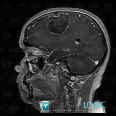 Dermoid cyst, Supratentorial peri cerebral spaces, Cerebral hemispheres, MRI