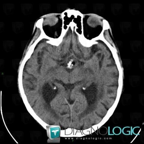 Dermoid cyst, Supratentorial peri cerebral spaces, CT