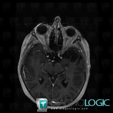 Dermoid cyst, Supratentorial peri cerebral spaces, MRI