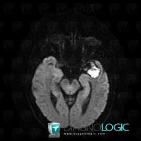 Dermoid cyst, Supratentorial peri cerebral spaces, MRI