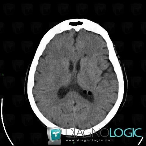 Dermoid cyst, Ventricles / Periventricular region, CT