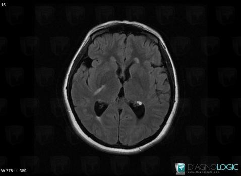 Dermoid cyst, Ventricles / Periventricular region, MRI