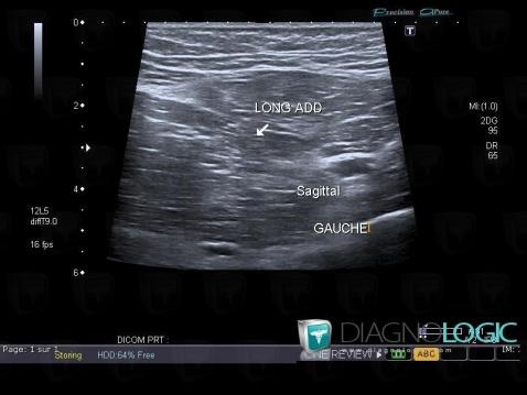 Désinsertion myo-aponévrotique, Muscles - Cuisse, Echographie