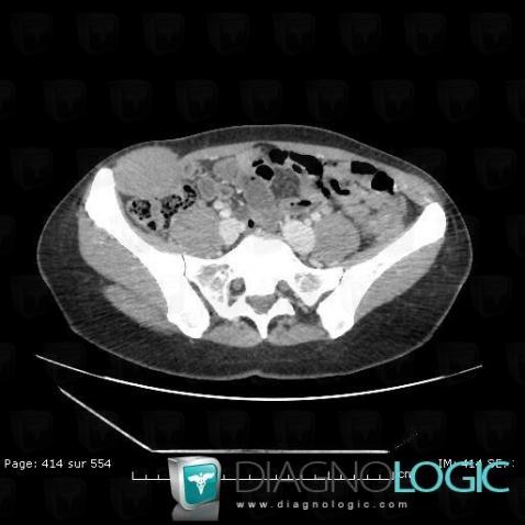 Desmoid tumor, Abdominal wall, CT