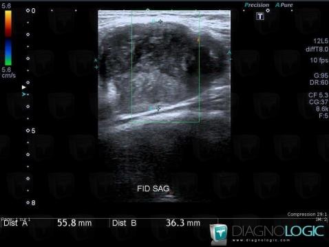 Desmoid tumor, Abdominal wall, US