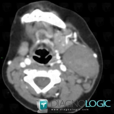 Desmoid tumor, Deep neck spaces, CT