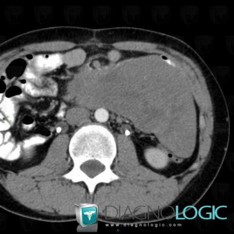 Desmoid tumor, Mesentery / Peritoneum, CT