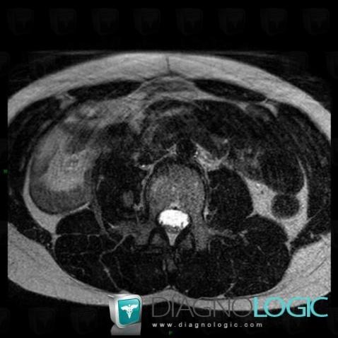 Desmoid tumor, Mesentery / Peritoneum, MRI