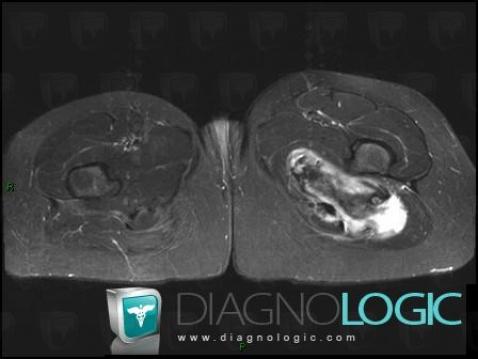 Desmoid tumor, Muscles - Thigh, Other soft tissues/nerves - Thigh, MRI