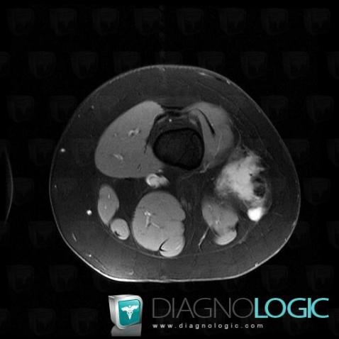 Desmoid tumor, Other soft tissues/nerves - Knee, MRI