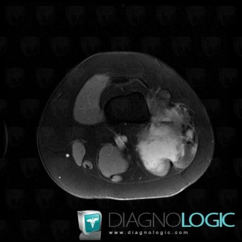 Desmoid tumor, Other soft tissues/nerves - Knee, MRI