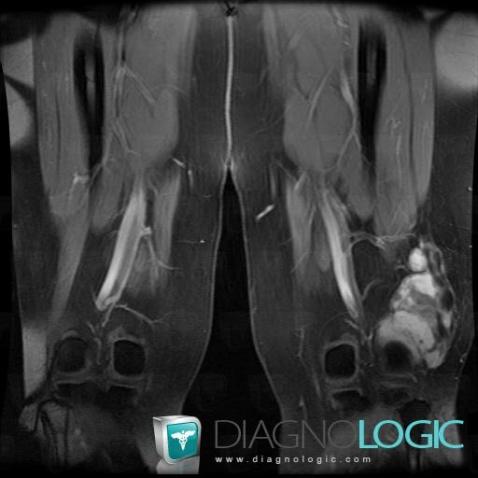 Desmoid tumor, Other soft tissues/nerves - Knee, MRI