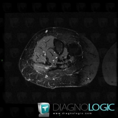 Desmoid tumor, Other soft tissues/nerves - Leg, MRI