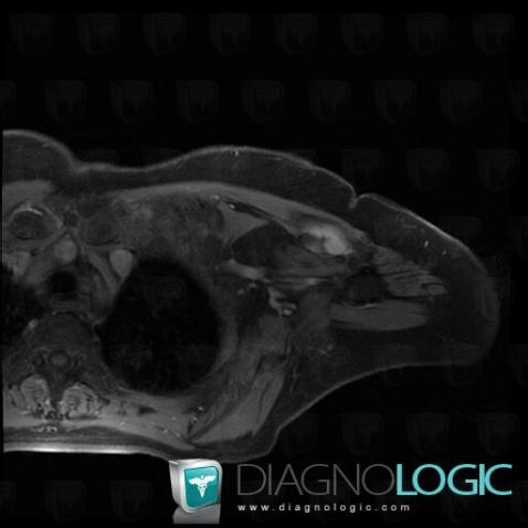 Desmoid tumor, Other soft tissues/nerves - Shoulder, MRI