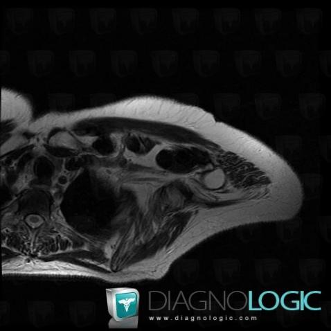 Desmoid tumor, Other soft tissues/nerves - Shoulder, MRI