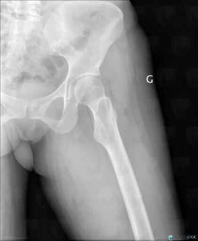 Desmoid tumor, Other soft tissues/nerves - Thigh, X rays