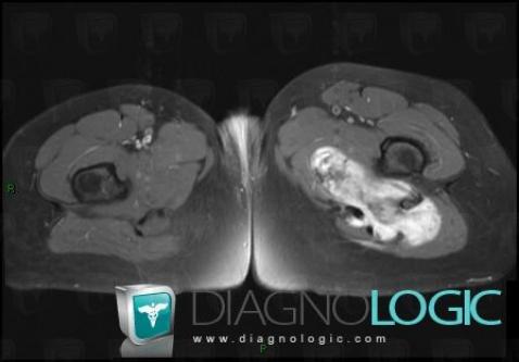 Desmoid tumor, Pelvic Muscles, Other soft tissues/nerves - Pelvis, MRI
